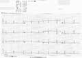 fig.2　カテコラミン感受性心室頻拍(安静時)の心電図