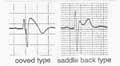 fig.8　Brugada症候群 右胸部誘導の心電図所見