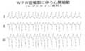 fig.15　WPW症候群偽性心室頻拍(学童) エプスタイン奇形合併