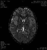 頭部MRI
