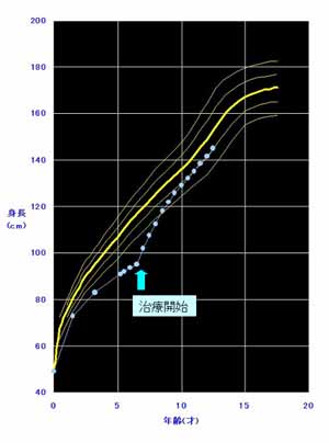 成長ホルモン分泌不全性低身長の男児例の図